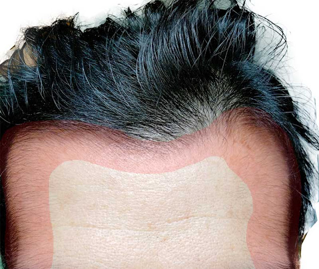 ＡＧＡ治療薬を飲み続けて約3か月以降の頭皮、髪の毛。その１