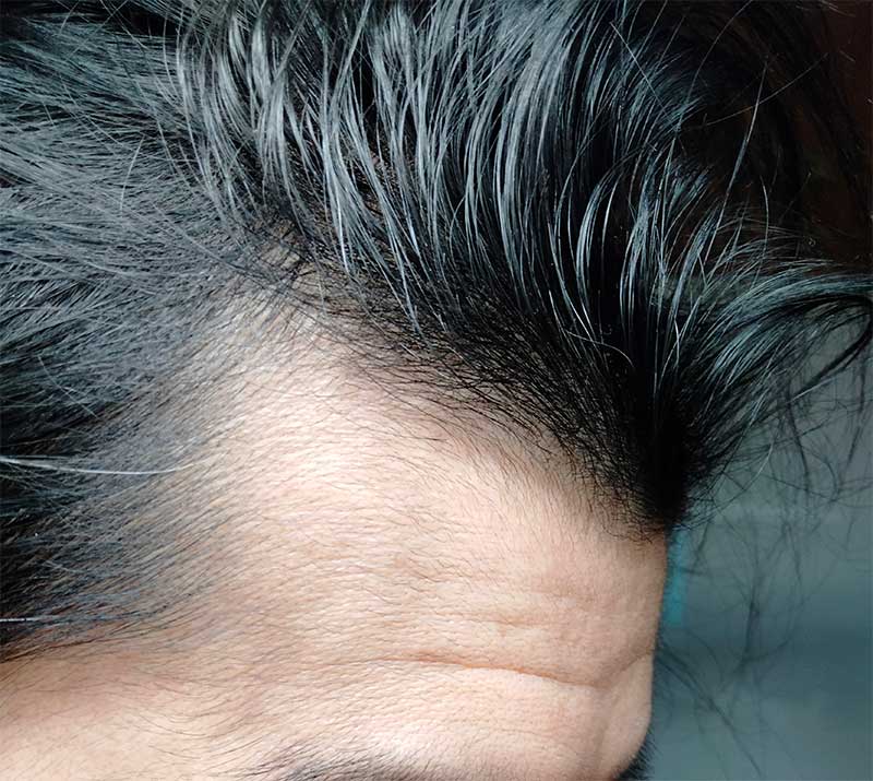 ＡＧＡ治療薬を飲み続けて約3か月以降の頭皮、髪の毛。その２