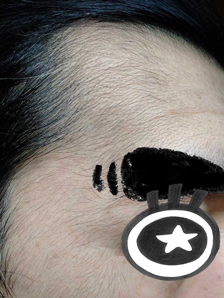 ＡＧＡ治療薬を飲み続けて約3か月以降の顔の毛