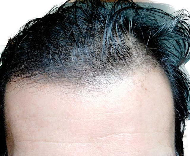 ＡＧＡ治療薬を飲む前の頭皮、髪の毛
